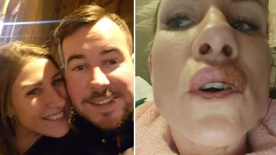 Htela duplu dozu filera: Usna EKSPLODIRALA 