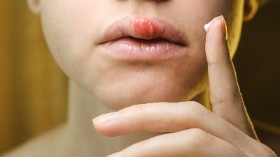 Herpes na usnama: Kako se leči i ublažava?