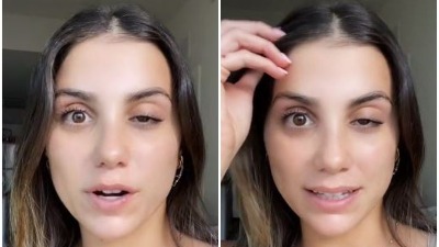 Ispeglala čelo botoksom, ali jedno nije očekivala (VIDEO)