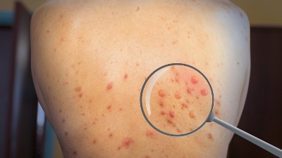 Dve osobe zaražene majmunskim boginjama u Severnoj Makedoniji: Poznato njihovo stanje