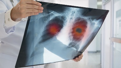 Piše dr Plavšić: Svetski dan borbe protiv bolesti pluća