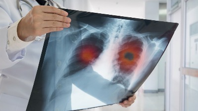 Skrining program za rano otkrivanje karcinoma pluća (DRUGI DEO)