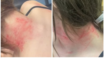 "Uzeo joj glavu i udarao o pločice": Tiktokerka pokazala sestrine povrede, pretukao je muž "Uzeo joj glavu i udarao o pločice": Tiktokerka pokazala sestrine povrede, pretukao je muž