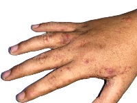 NPS: Vlast ignoriše da se šuga pojavljuje u kolektivima u kojima su zaposleni strani radnici