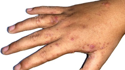 NPS: Vlast ignoriše da se šuga pojavljuje u kolektivima u kojima su zaposleni strani radnici