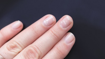 Bele mrlje na noktima mogu biti simptomi opasnih bolesti