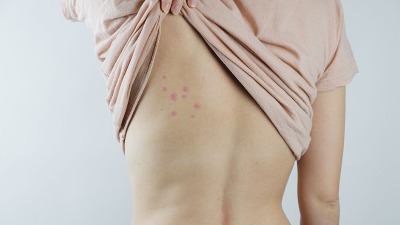 Turisti napustili Hrvatsku zbog neobičnih fleka po telu (FOTO)