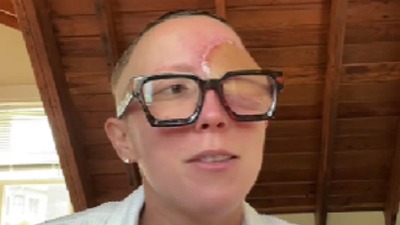 Ukazivalo na sinusnu infekciju, izgubila oko (VIDEO)