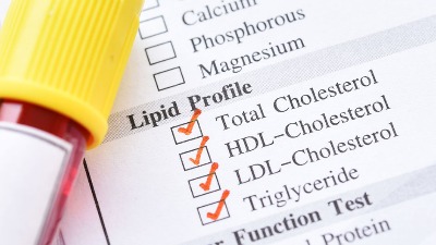 3 vidljiva znaka visokog holesterola - možete da ih uočite na telu 
