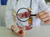 Onkolog upozorava na tihi simptom raka creva koji mnogi ignorišu