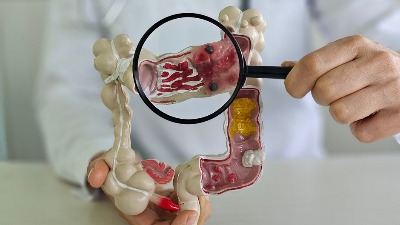 Onkolog upozorava na tihi simptom raka creva koji mnogi ignorišu