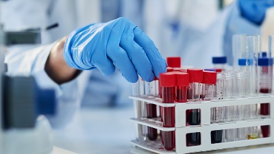 Parametar u krvi koji treba da prekontrolišete ako sumnjate da ste anemični - a nije gvožđe