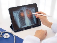 7 simptoma UPALE PLUĆA: Ako ih primetite ODMAH se JAVITE LEKARU 