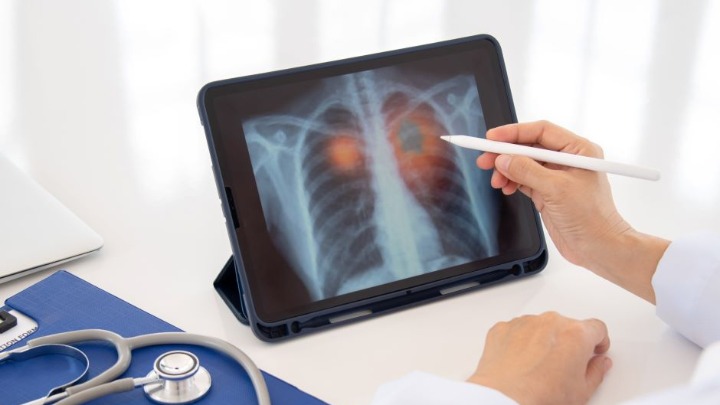 7 simptoma UPALE PLUĆA: Ako ih primetite ODMAH se JAVITE LEKARU 