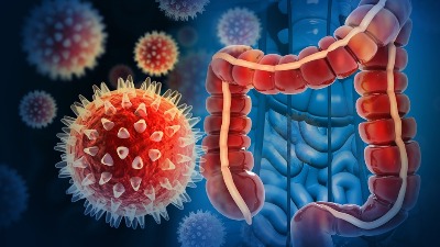 Uzorci tumora stari više od jednog veka mogli bi da otkriju uzroke povećanja broja raka creva kod mladih