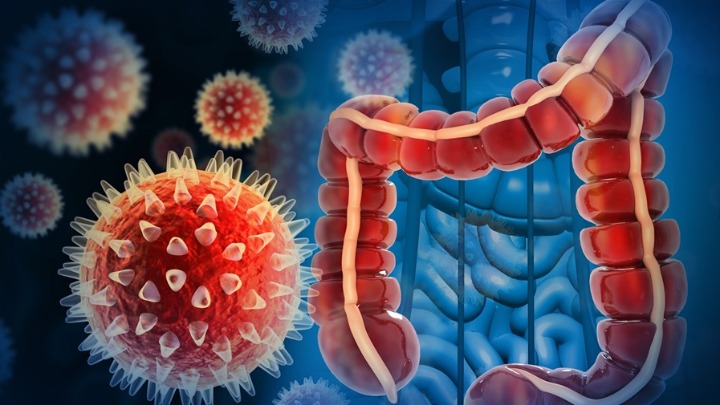 Uzorci tumora stari više od jednog veka mogli bi da otkriju uzroke povećanja broja raka creva kod mladih