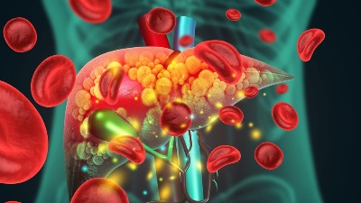 Lekari upozoravaju! Uobičajeni OBLIK TELA može biti prvi simptom MASNE JETRE - a uopšte ne morate biti gojazni