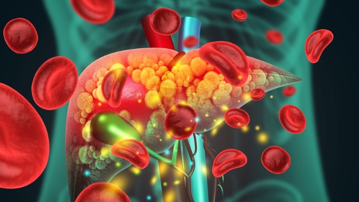 Lekari upozoravaju! Uobičajeni OBLIK TELA može biti prvi simptom MASNE JETRE - a uopšte ne morate biti gojazni