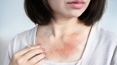 OVE promene na koži mogu da ukažu na OPASNE KARDIOVASKULARNE PROBLEME 