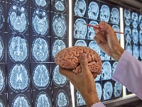 Neurohirurg (92) otkriva da OVAJ DESERT održava MOZAK MLADIM: Možete ga jesti svaki dan, ali pod jednim uslovom