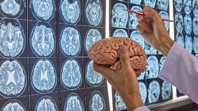 Neurohirurg (92) otkriva da OVAJ DESERT održava MOZAK MLADIM: Možete ga jesti svaki dan, ali pod jednim uslovom