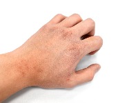 Kako sprečiti ljuštenje kože zimi?