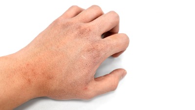 Kako sprečiti ljuštenje kože zimi?