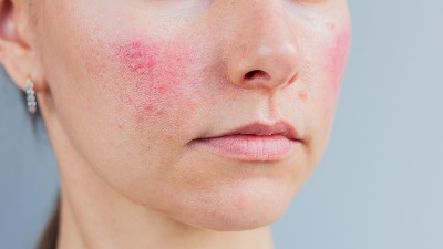 LICE VAM POCRVENI kada pijete alkohol? Lekar otkrio UZNEMIRUJUĆU ISTINU 