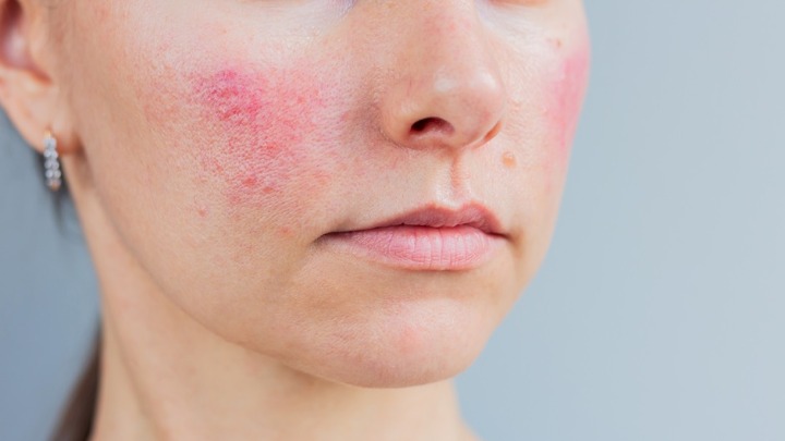 LICE VAM POCRVENI kada pijete alkohol? Lekar otkrio UZNEMIRUJUĆU ISTINU 