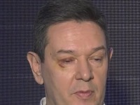 Šarović se pojavio sa povredom oka! Evo šta kaže (FOTO)