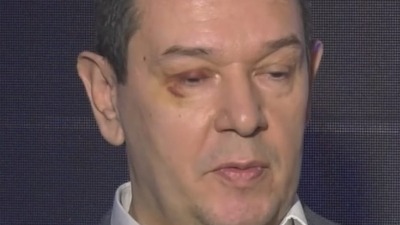 Šarović se pojavio sa povredom oka! Evo šta kaže (FOTO)